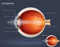 lasik-mata-harga-terjangkau