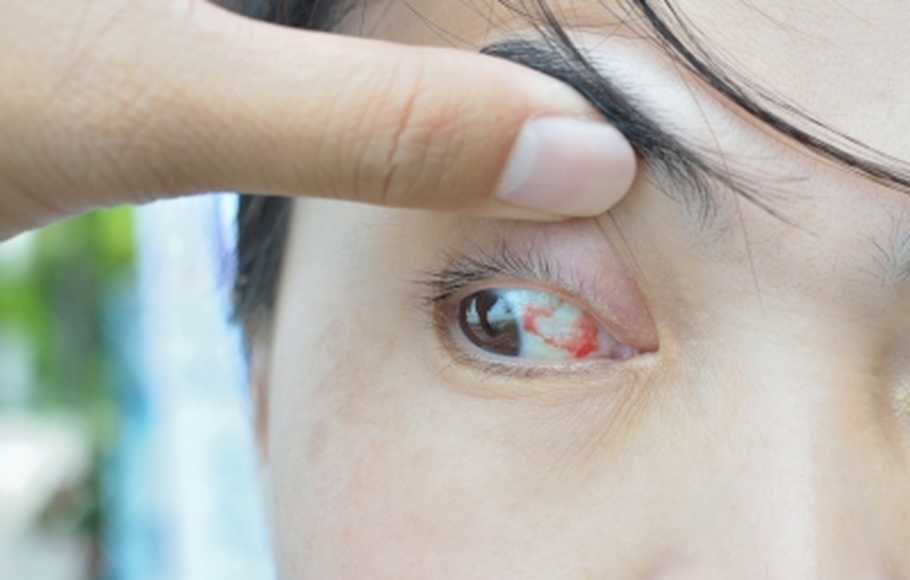 tangkal-berbagai-gangguan-mata-dengan-rumus-20-20-silc-lasik-center