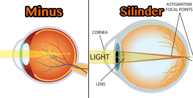 Apakah Operasi LASIK bisa Menghilangkan Mata Minus dan Silinder Sekaligus?